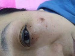 -美人痣全国连锁