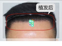 -大麦微针植发全国连锁