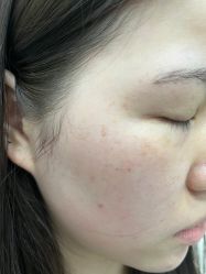 体验后-郑荃丽格医疗美容