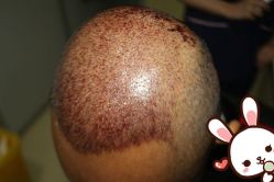 点击看大图 -大麦微针植发丨全国连锁