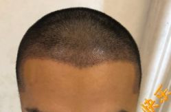 -大麦微针植发丨全国连锁