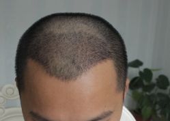 -大麦微针植发全国连锁