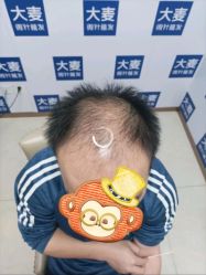 -大麦微针植发丨全国连锁