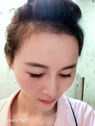 -大麦微针植发丨全国连锁