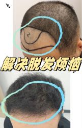 -大麦微针植发全国连锁