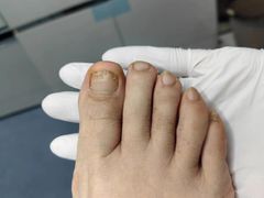 -Andrew指甲专科灰指甲·甲沟炎矫正·3D步态矫形鞋垫定制(上海法华镇路旗舰店)