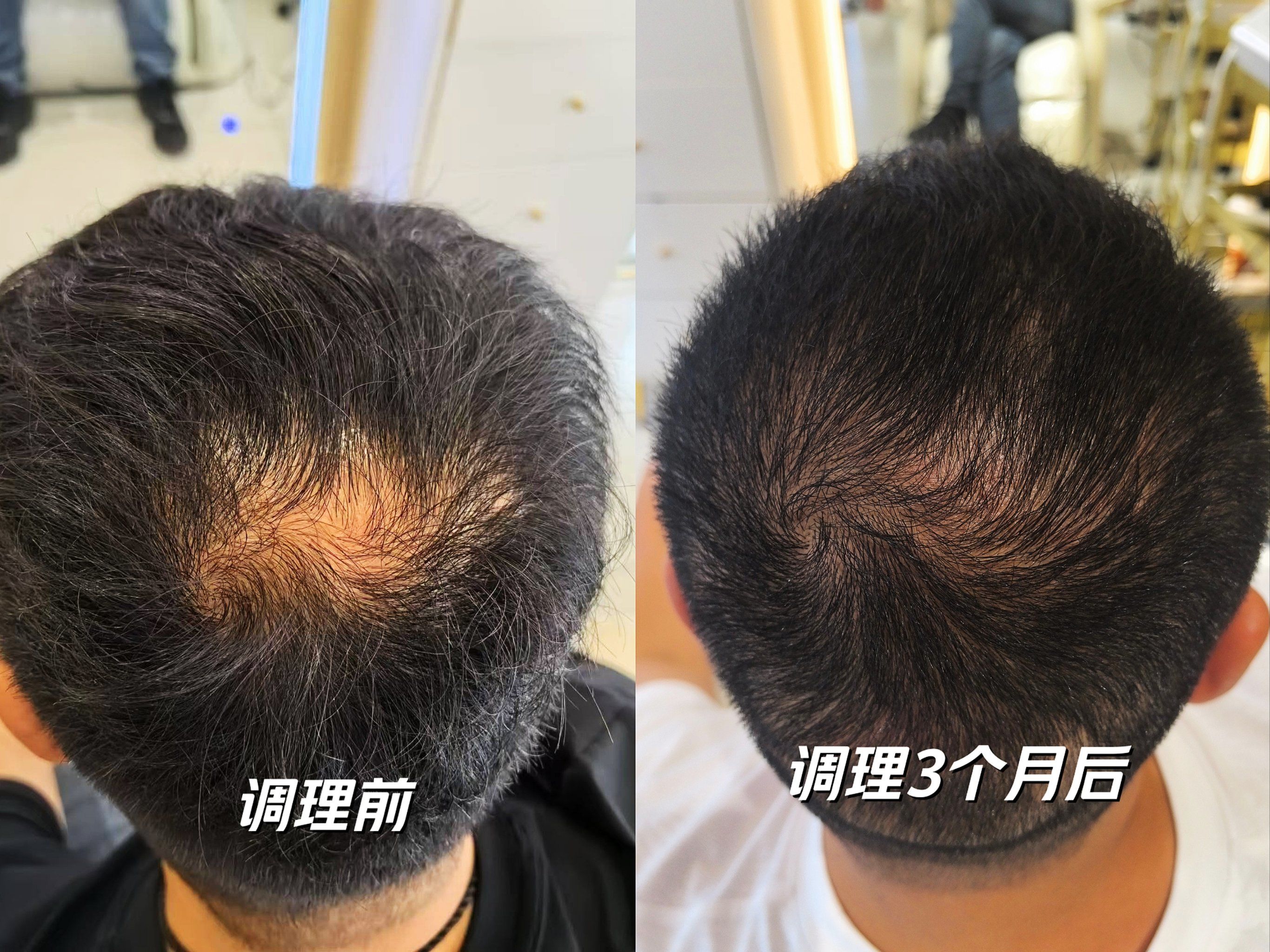 脱发什么原因？中医怎么调理？新加坡贡方堂TCM皮肤科专家一文说清！