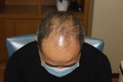 -大麦微针植发全国连锁