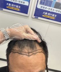 -大麦微针植发全国连锁