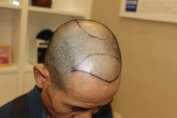 -大麦微针植发丨全国连锁