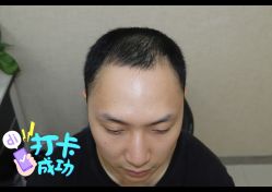 -大麦微针植发全国连锁