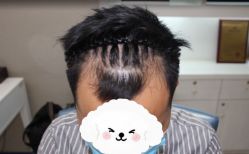 体验前-大麦微针植发全国连锁