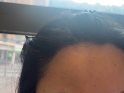 -碧莲盛·不剃发植发