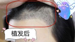 -大麦微针植发全国连锁