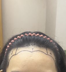 -大麦微针植发全国连锁