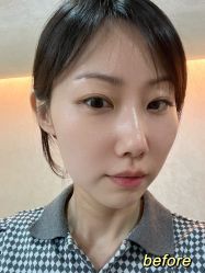 点击看大图 体验前-天津时光诺颜·轻医美·轮廓抗衰中心