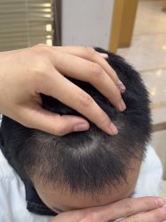 -大麦微针植发丨全国连锁