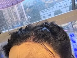 -碧莲盛·不剃发植发