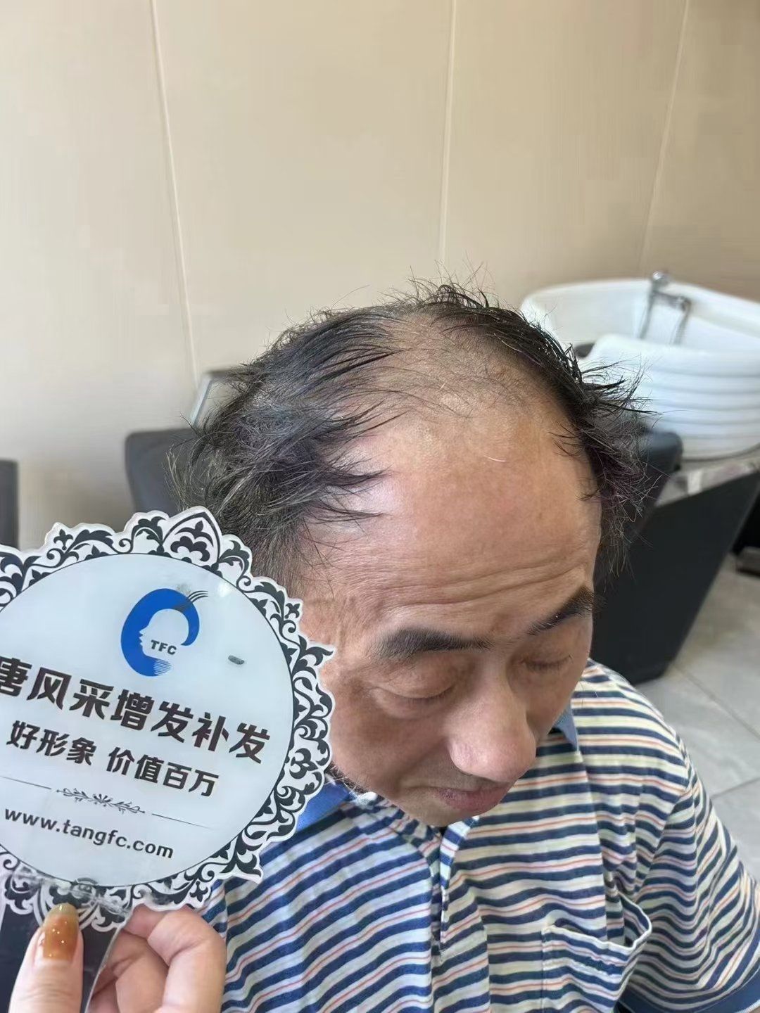 60岁的先生头顶脱发严重
