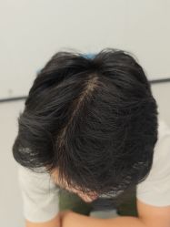 -大麦微针植发全国连锁