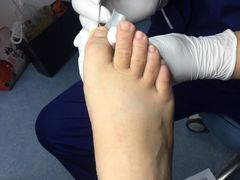 -Andrew指甲专科灰指甲·甲沟炎矫正·3D步态矫形鞋垫定制(上海法华镇路旗舰店)