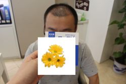 -大麦微针植发丨全国连锁