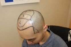 -大麦微针植发丨全国连锁