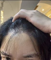 -大麦微针植发丨全国连锁