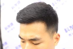 -大麦微针植发丨全国连锁