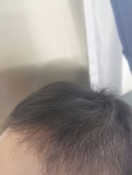 -碧莲盛·不剃发植发