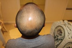 -大麦微针植发丨全国连锁