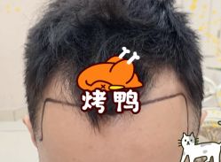 -大麦微针植发全国连锁