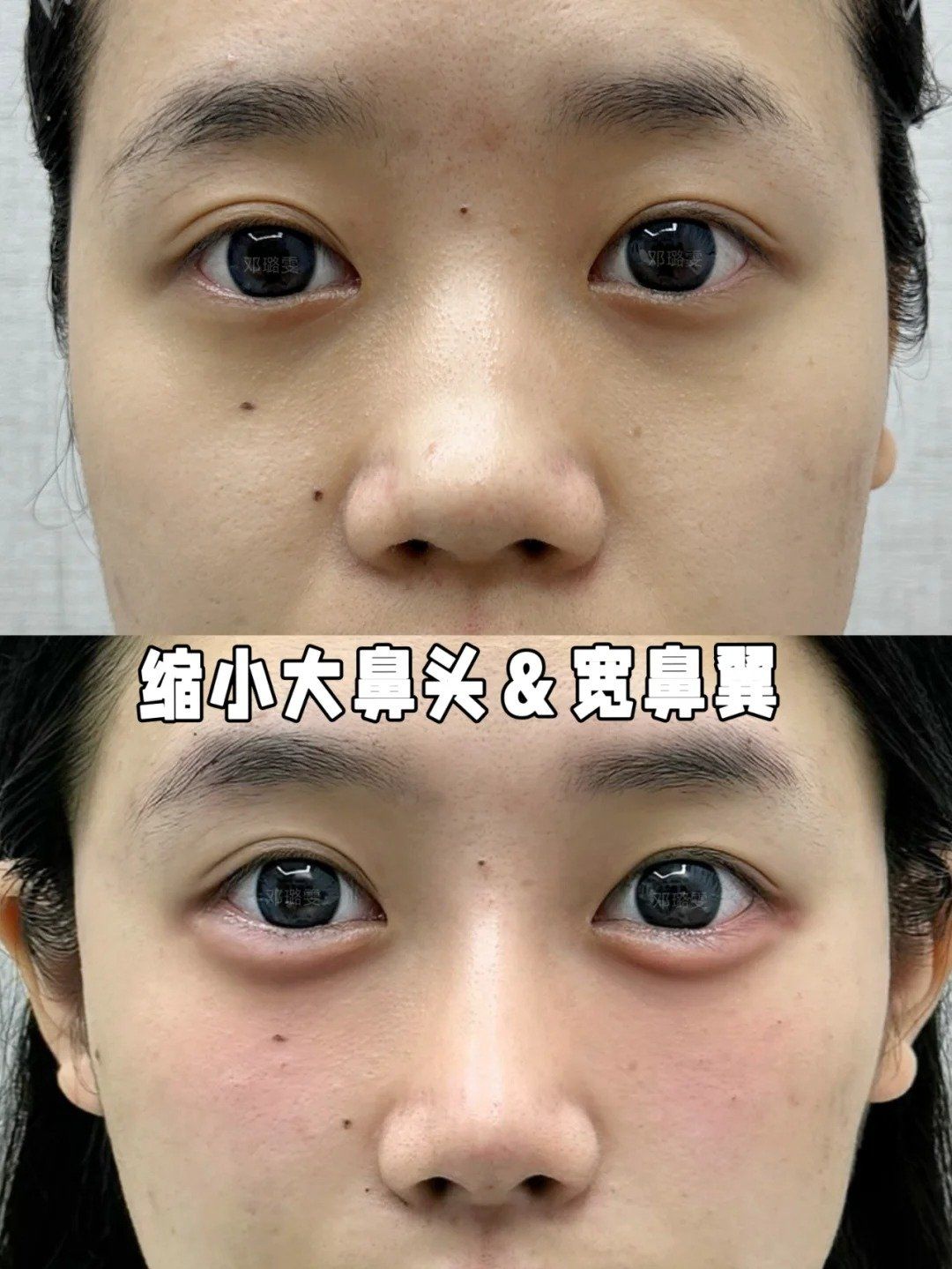 建议基础好的姐妹们试试不刀刀91鼻,山根 双c 鼻背 鼻尖 鼻小柱