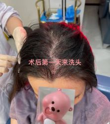 体验后-大麦微针植发全国连锁