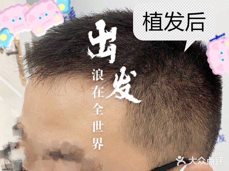 大麦微针植发全国连锁(长沙分院)图片