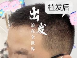 -大麦微针植发全国连锁