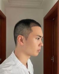 -大麦微针植发丨全国连锁