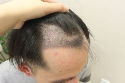 -大麦微针植发丨全国连锁