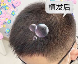 -大麦微针植发全国连锁