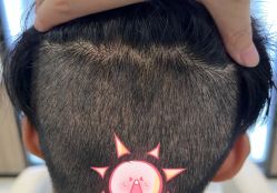 -大麦微针植发全国连锁