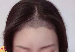 -大麦微针植发丨全国连锁