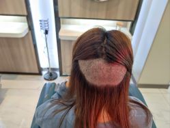 体验后-大麦微针植发丨全国连锁