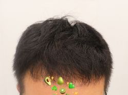 -大麦微针植发全国连锁