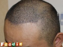 -大麦微针植发丨全国连锁