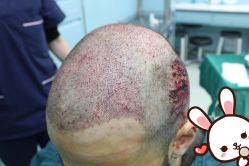 点击看大图 -大麦微针植发丨全国连锁