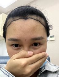 -大麦微针植发丨全国连锁