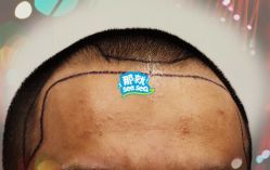 -大麦微针植发全国连锁