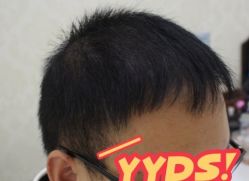 -大麦微针植发丨全国连锁