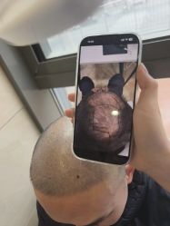 -碧莲盛·不剃发植发