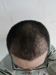 -碧莲盛·不剃发植发